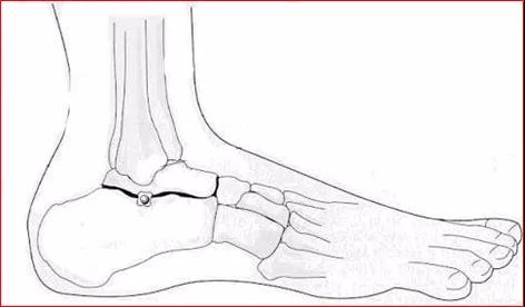 医用几丁糖是什么20种关节腔穿刺技术，你想知道的都在这了！_https://www.jmylbn.com_新闻资讯_第25张