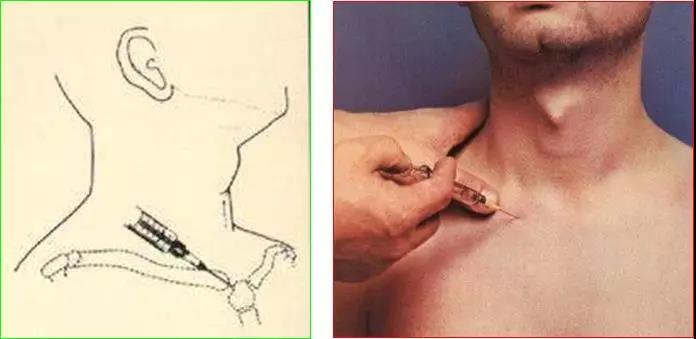医用几丁糖是什么20种关节腔穿刺技术，你想知道的都在这了！_https://www.jmylbn.com_新闻资讯_第32张