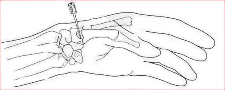 医用几丁糖是什么20种关节腔穿刺技术，你想知道的都在这了！_https://www.jmylbn.com_新闻资讯_第24张