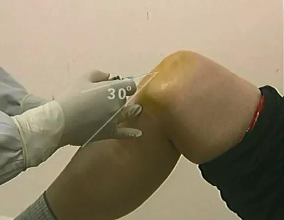 医用几丁糖是什么20种关节腔穿刺技术，你想知道的都在这了！_https://www.jmylbn.com_新闻资讯_第4张