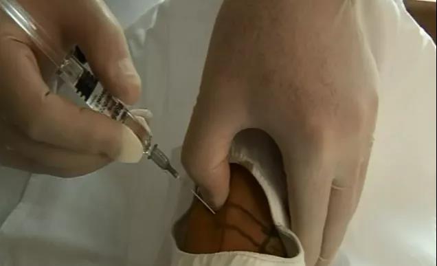 医用几丁糖是什么20种关节腔穿刺技术，你想知道的都在这了！_https://www.jmylbn.com_新闻资讯_第30张