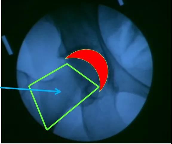 医用几丁糖是什么20种关节腔穿刺技术，你想知道的都在这了！_https://www.jmylbn.com_新闻资讯_第8张