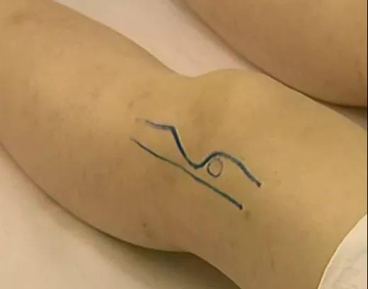 医用几丁糖是什么20种关节腔穿刺技术，你想知道的都在这了！_https://www.jmylbn.com_新闻资讯_第5张