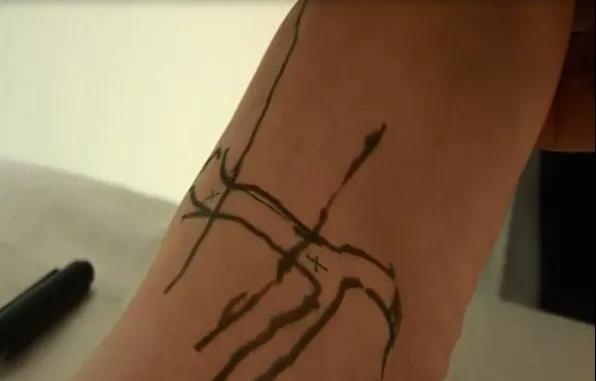 医用几丁糖是什么20种关节腔穿刺技术，你想知道的都在这了！_https://www.jmylbn.com_新闻资讯_第27张