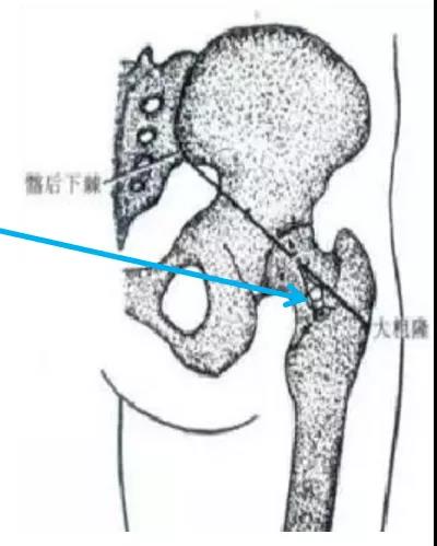 医用几丁糖是什么20种关节腔穿刺技术，你想知道的都在这了！_https://www.jmylbn.com_新闻资讯_第12张