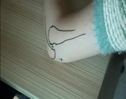 医用几丁糖是什么20种关节腔穿刺技术，你想知道的都在这了！_https://www.jmylbn.com_新闻资讯_第19张