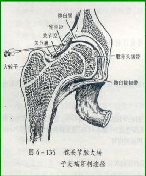 医用几丁糖是什么20种关节腔穿刺技术，你想知道的都在这了！_https://www.jmylbn.com_新闻资讯_第10张