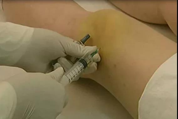 医用几丁糖是什么20种关节腔穿刺技术，你想知道的都在这了！_https://www.jmylbn.com_新闻资讯_第6张