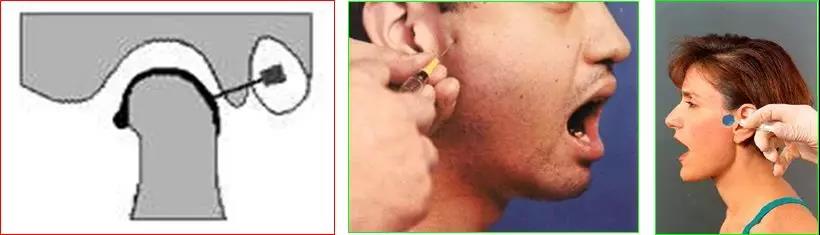 医用几丁糖是什么20种关节腔穿刺技术，你想知道的都在这了！_https://www.jmylbn.com_新闻资讯_第26张