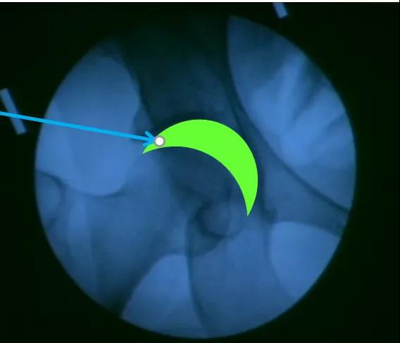 医用几丁糖是什么20种关节腔穿刺技术，你想知道的都在这了！_https://www.jmylbn.com_新闻资讯_第7张