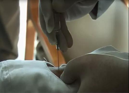 医用几丁糖是什么20种关节腔穿刺技术，你想知道的都在这了！_https://www.jmylbn.com_新闻资讯_第23张